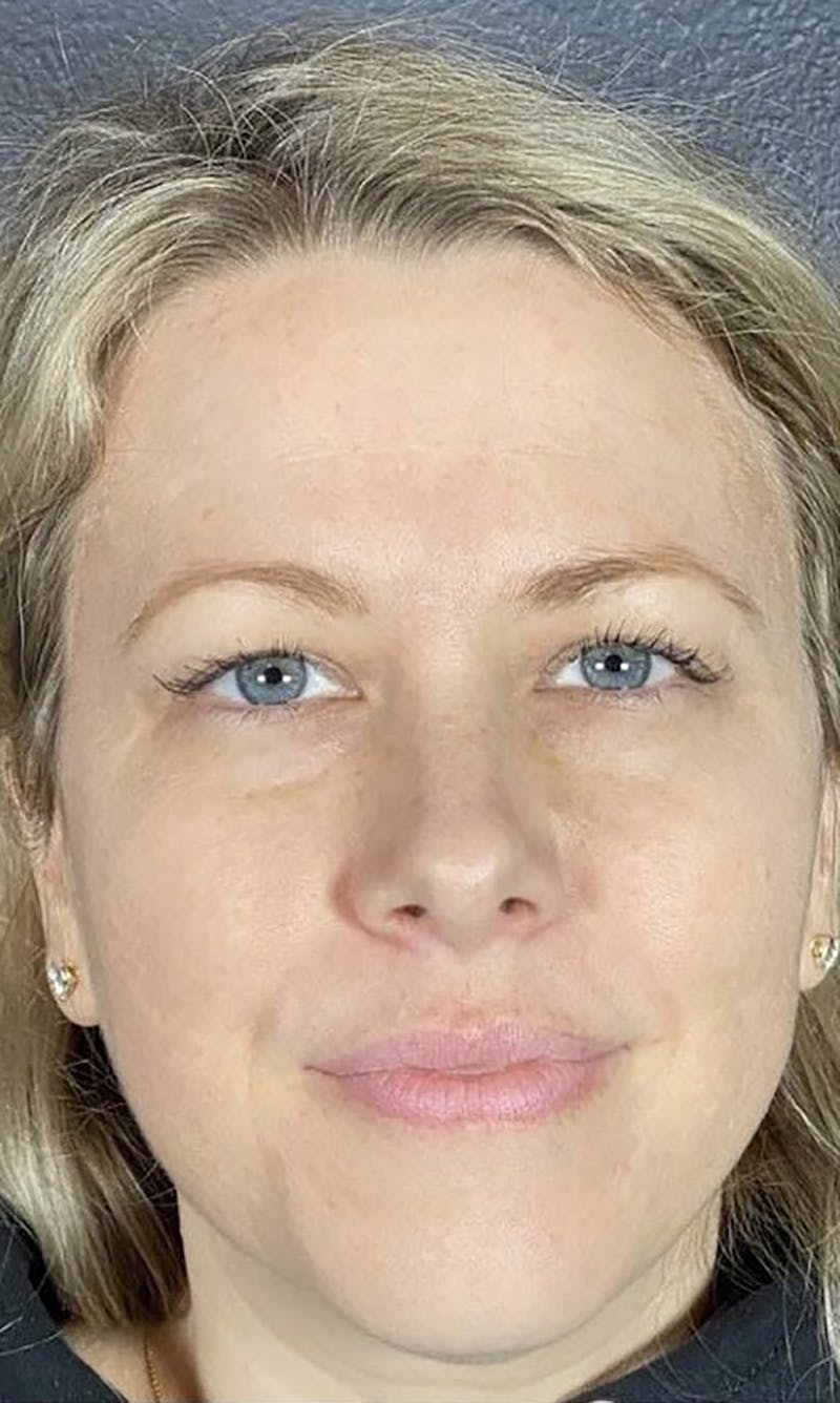 Microneedling Before & After Gallery - Patient 66604065 - Image 2