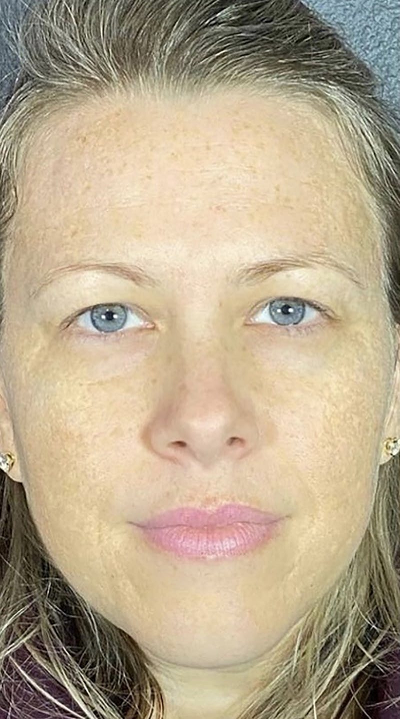 Microneedling Before & After Gallery - Patient 66604065 - Image 1