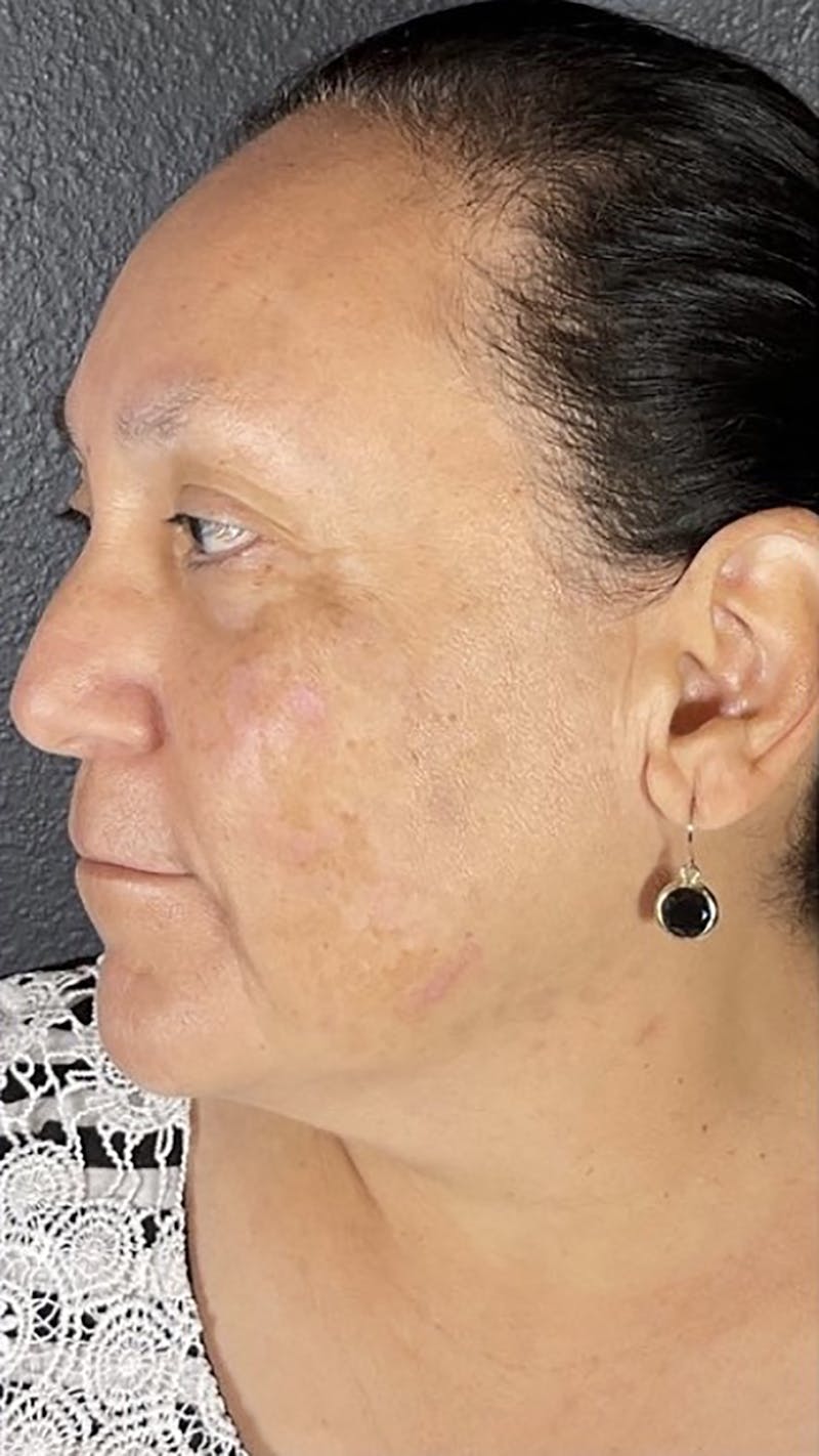 Microneedling Before & After Gallery - Patient 66604066 - Image 2