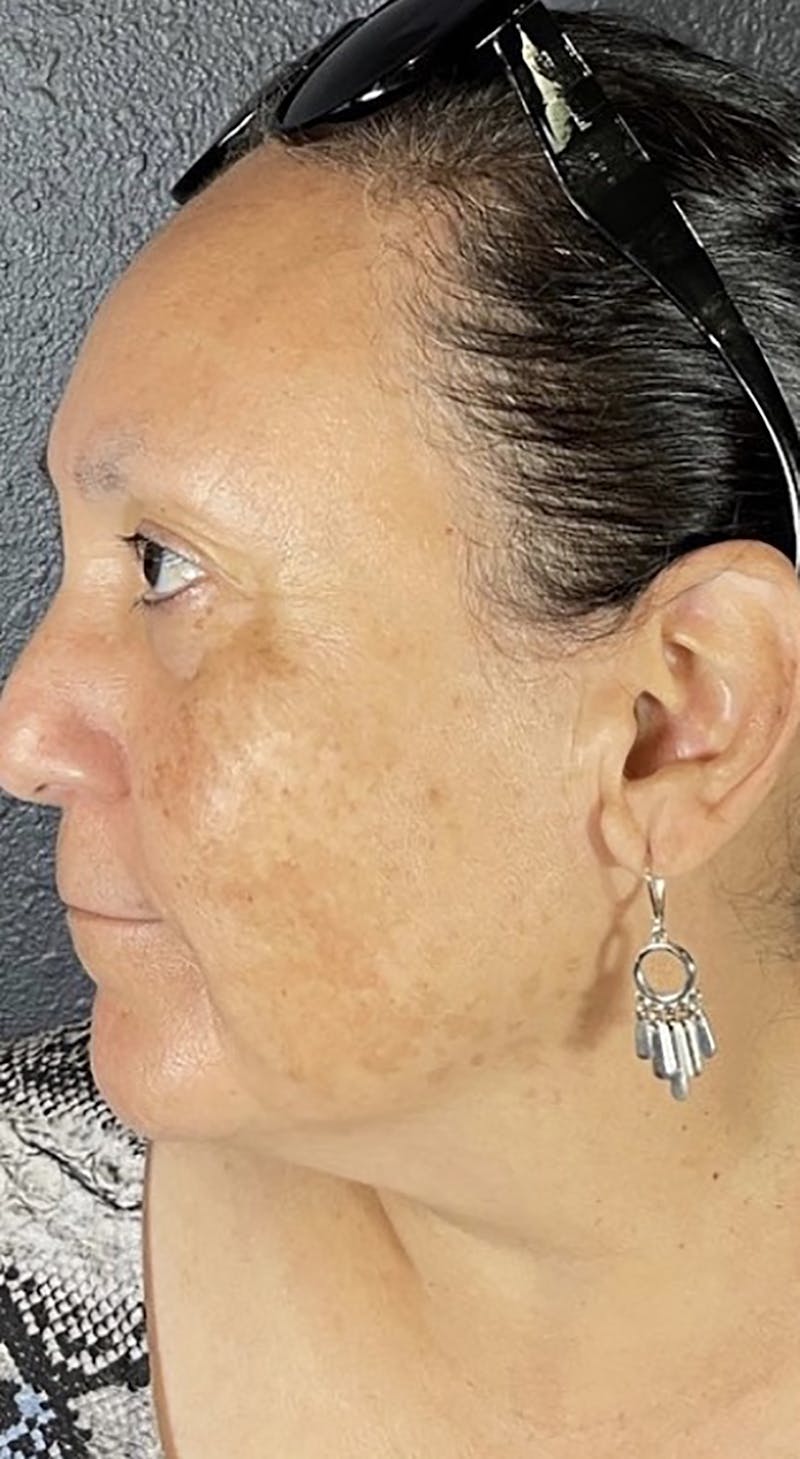 Microneedling Before & After Gallery - Patient 66604066 - Image 1