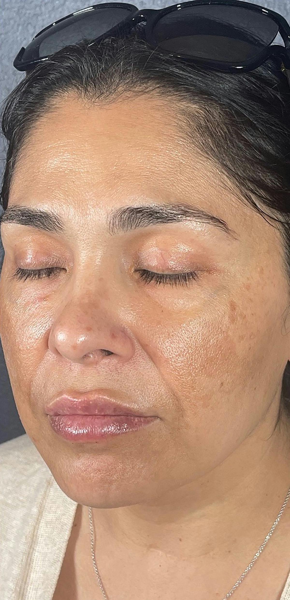 Microneedling in San Antonio Before & After Photos