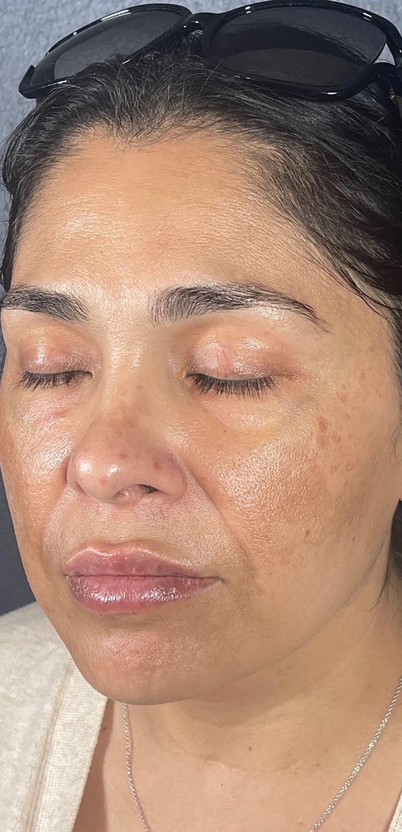 Microneedling Before & After Gallery - Patient 66604067 - Image 2