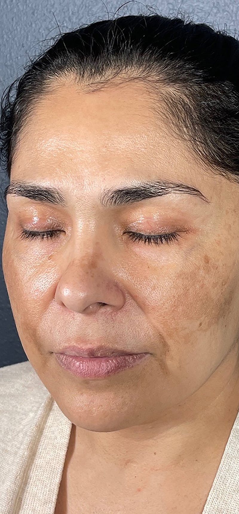 Microneedling Before & After Gallery - Patient 66604067 - Image 1