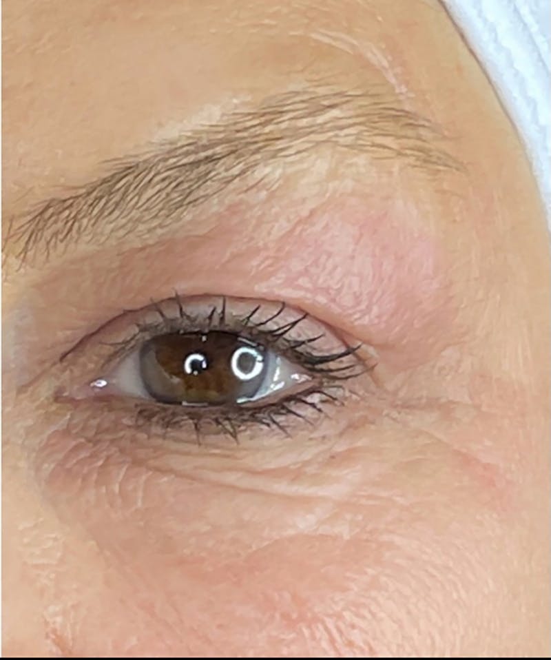 Plasma Pen Before & After Gallery - Patient 66604073 - Image 1