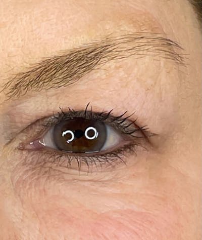 Plasma Pen Before & After Gallery - Patient 66604073 - Image 2