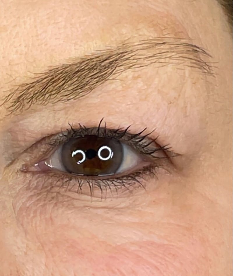 Plasma Pen Before & After Gallery - Patient 66604073 - Image 2