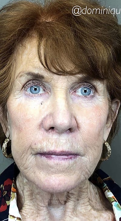 Threads Before & After Gallery - Patient 66604082 - Image 1