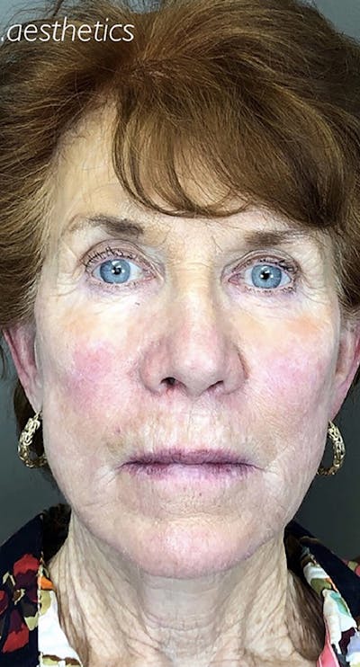 Threads Before & After Gallery - Patient 66604082 - Image 2