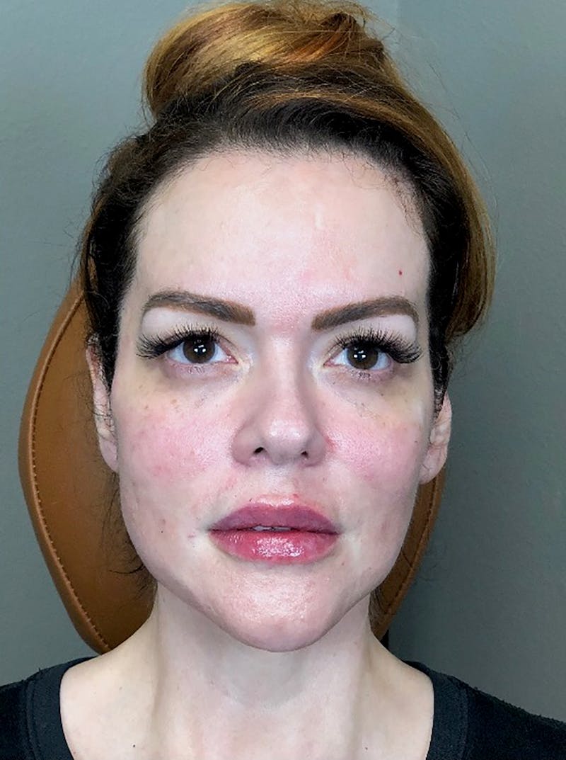 Threads Before & After Gallery - Patient 66604083 - Image 2