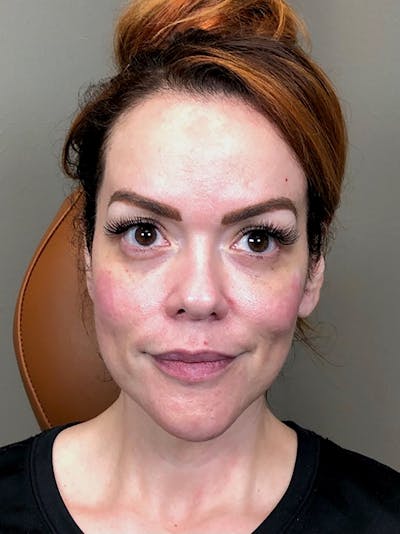 Threads Before & After Gallery - Patient 66604083 - Image 1