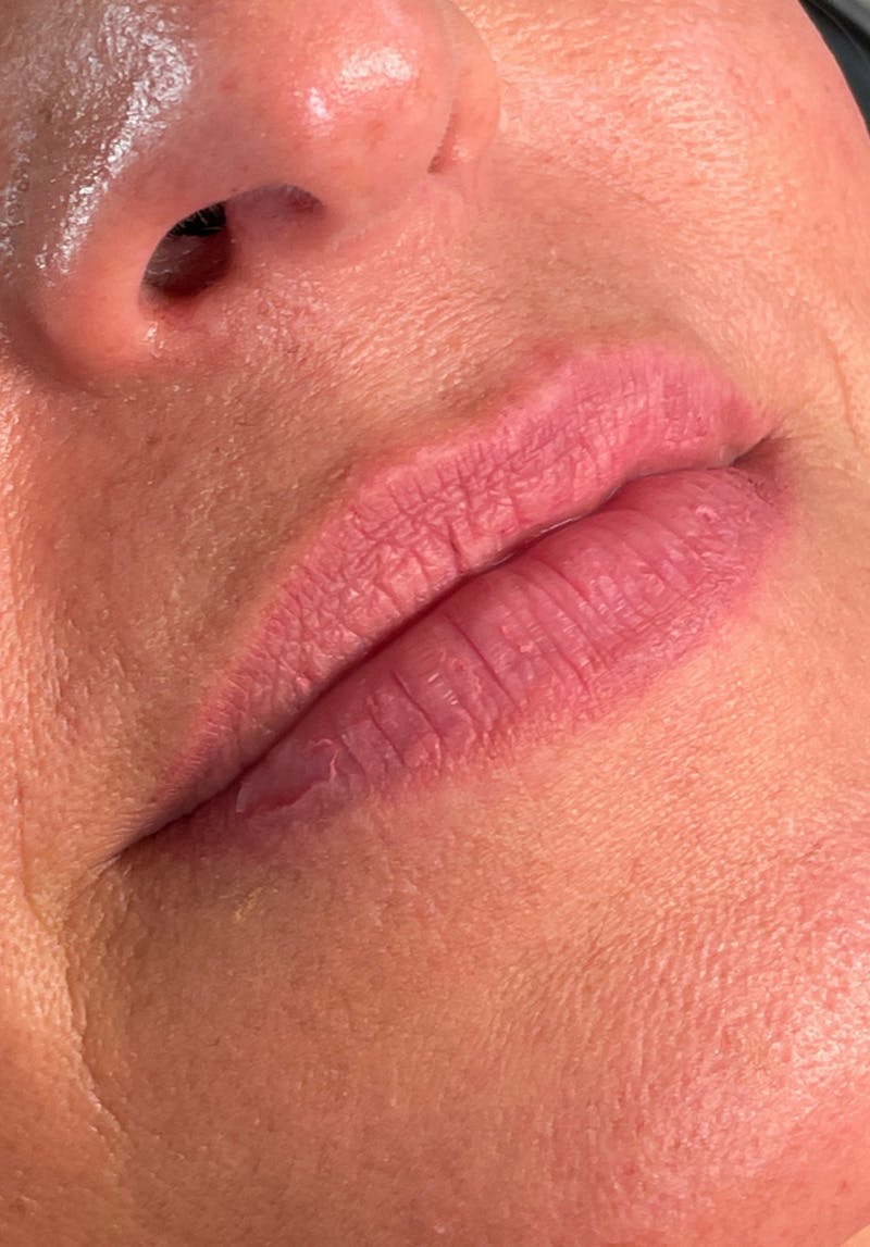 Dermal Fillers Before & After Gallery - Patient 142927797 - Image 1