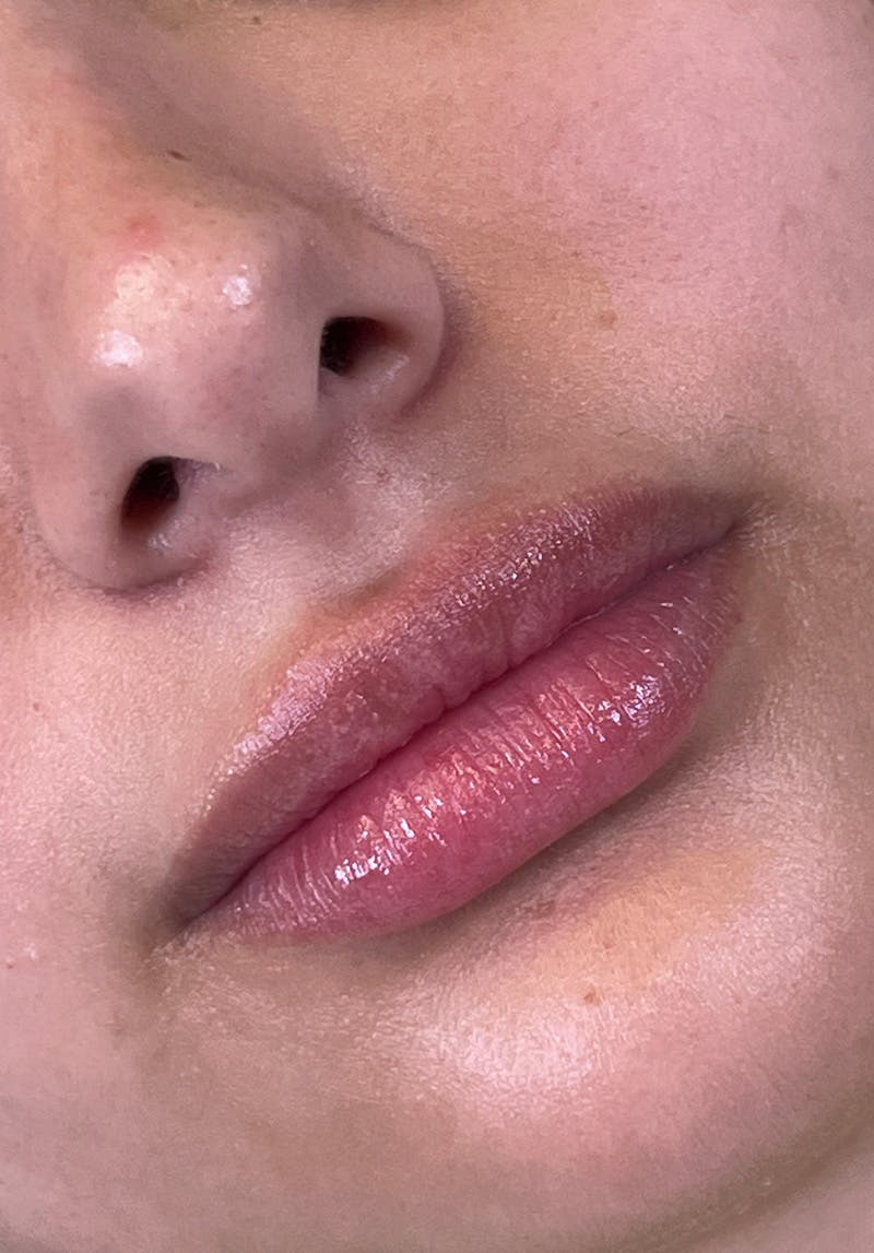 Dermal Fillers Before & After Gallery - Patient 142927796 - Image 1