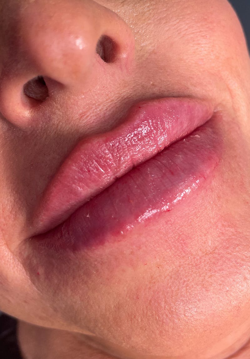 Dermal Fillers Before & After Gallery - Patient 142927797 - Image 2