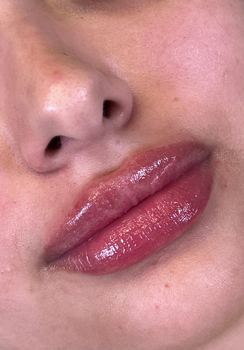 Dermal Fillers Before & After Gallery - Patient 142927796 - Image 2