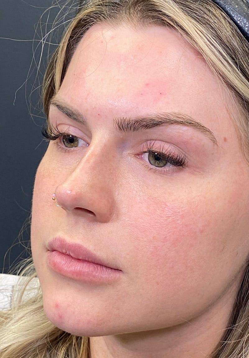 Dermal Fillers Before & After Gallery - Patient 142927795 - Image 1