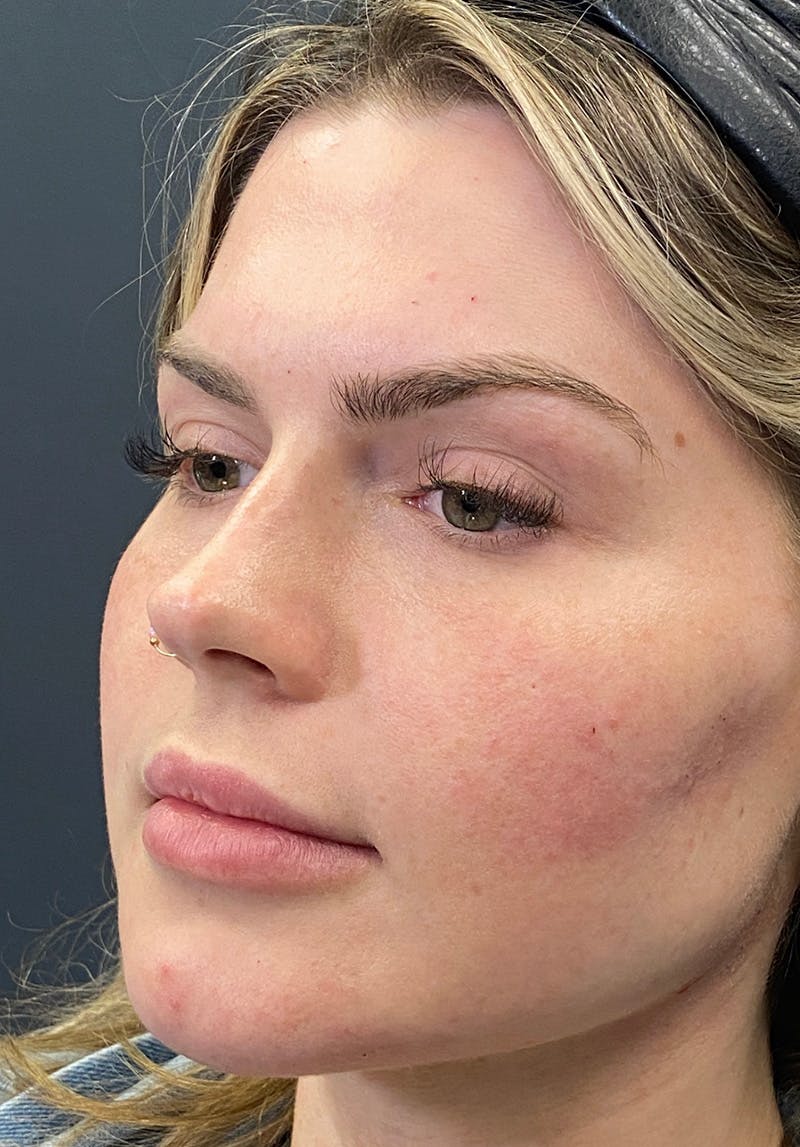 Dermal Fillers Before & After Gallery - Patient 142927795 - Image 2