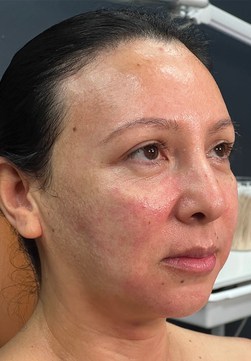 Dermal Fillers Before & After Gallery - Patient 142927794 - Image 1