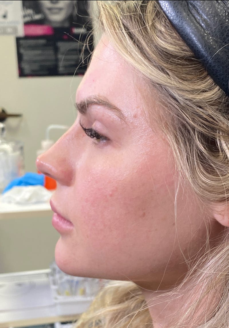 Dermal Fillers Before & After Gallery - Patient 142927795 - Image 3