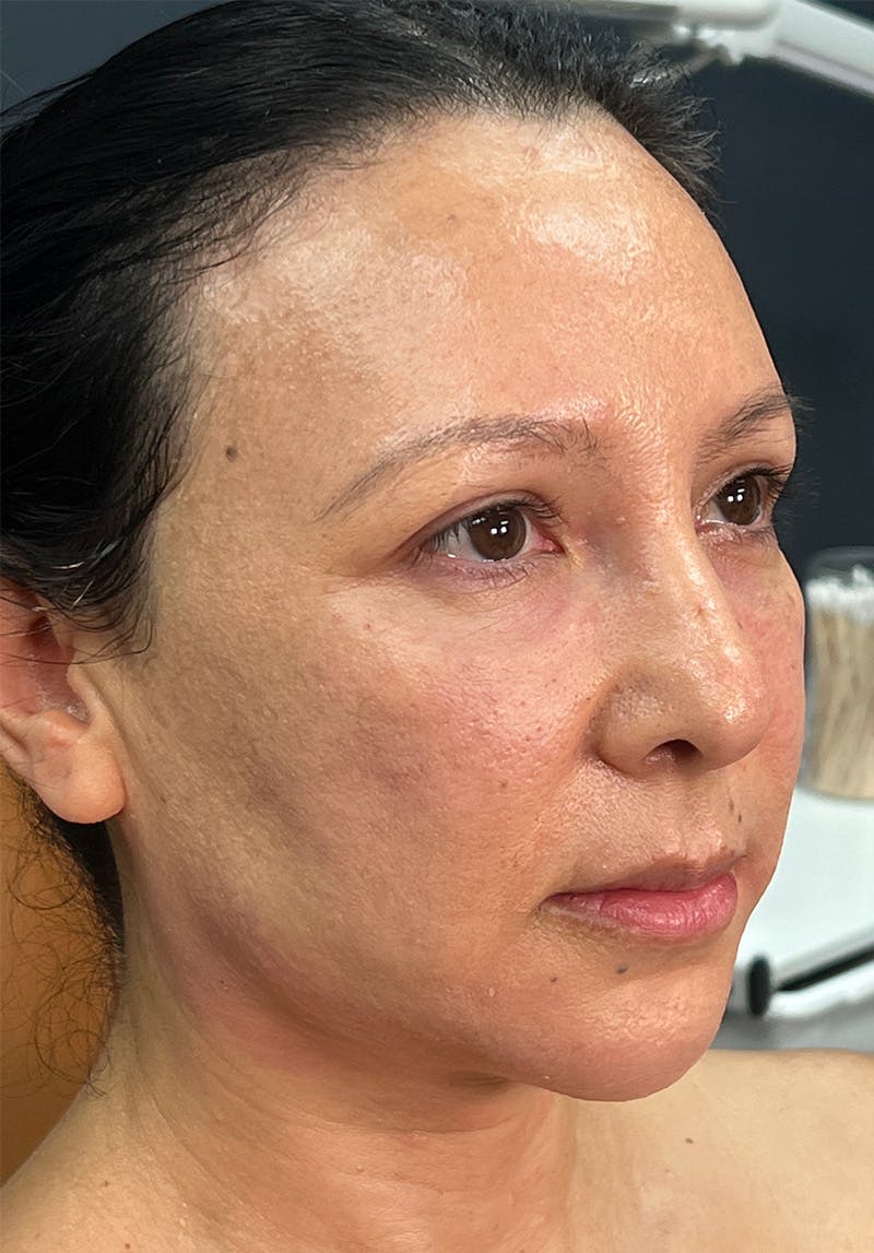 Dermal Fillers Before & After Gallery - Patient 142927794 - Image 2