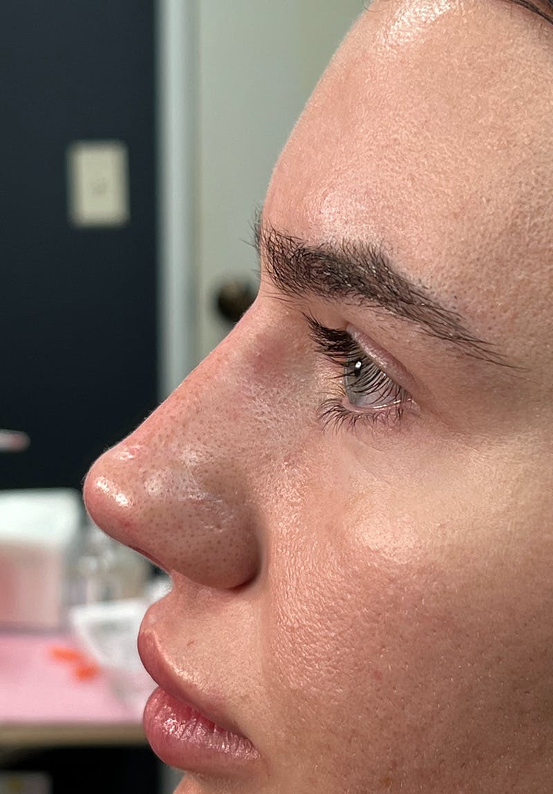 Dermal Fillers Before & After Gallery - Patient 142927793 - Image 1