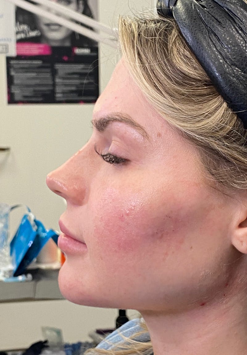 Dermal Fillers Before & After Gallery - Patient 142927795 - Image 4