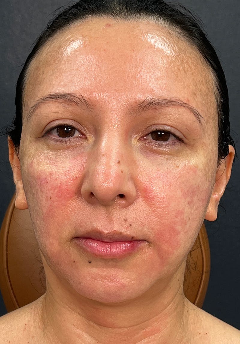 Dermal Fillers Before & After Gallery - Patient 142927794 - Image 3