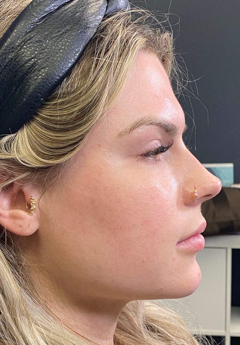 Dermal Fillers Before & After Gallery - Patient 142927795 - Image 5