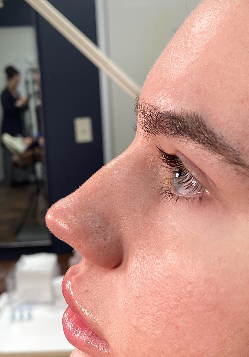 Dermal Fillers Before & After Gallery - Patient 142927793 - Image 2