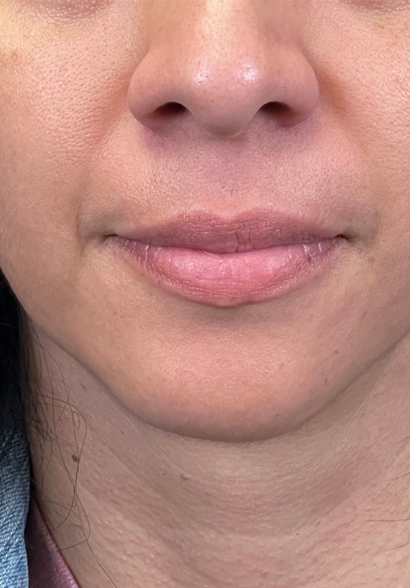 Dermal Fillers Before & After Gallery - Patient 142927792 - Image 1