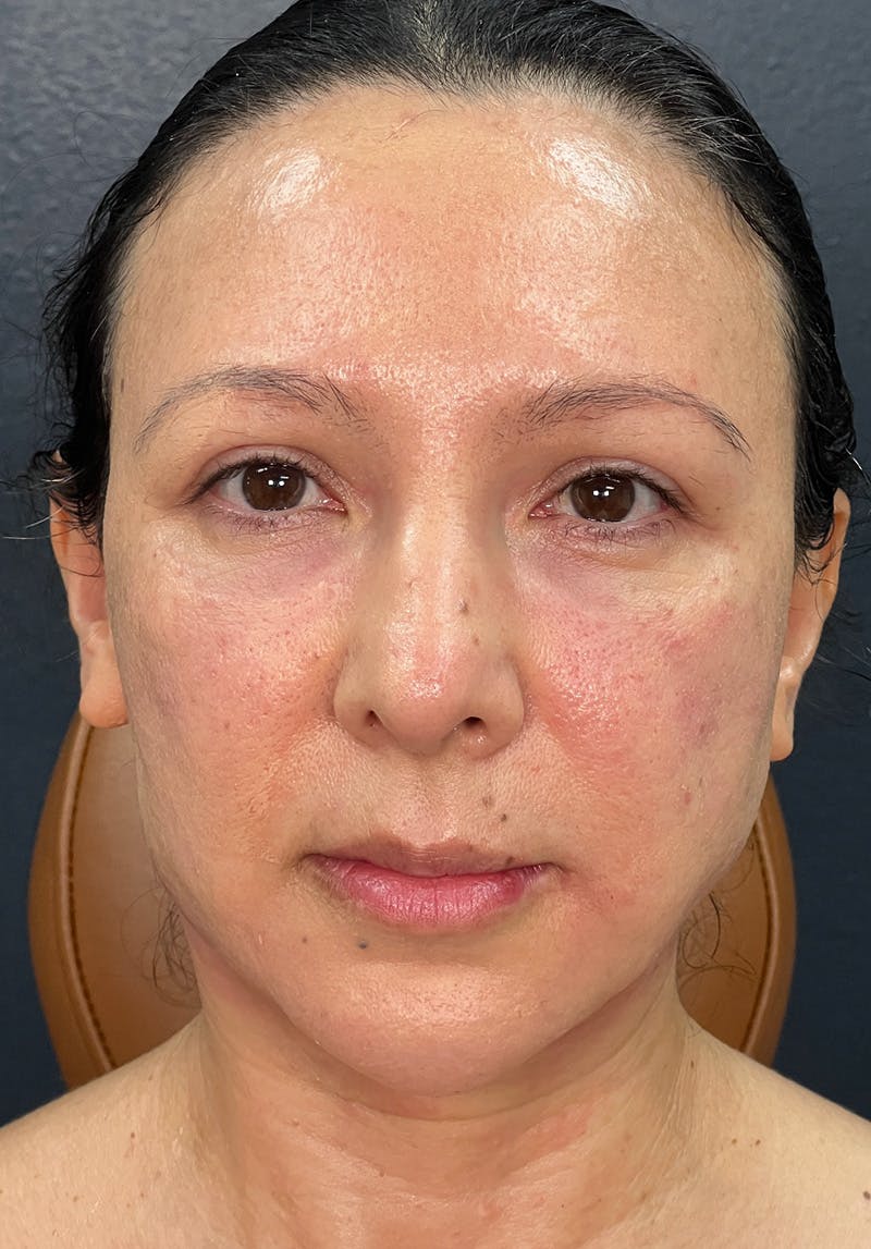 Dermal Fillers Before & After Gallery - Patient 142927794 - Image 4