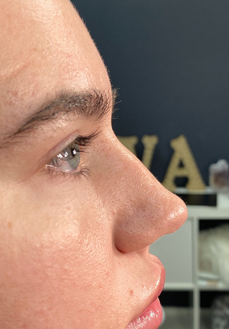 Dermal Fillers Before & After Gallery - Patient 142927793 - Image 3