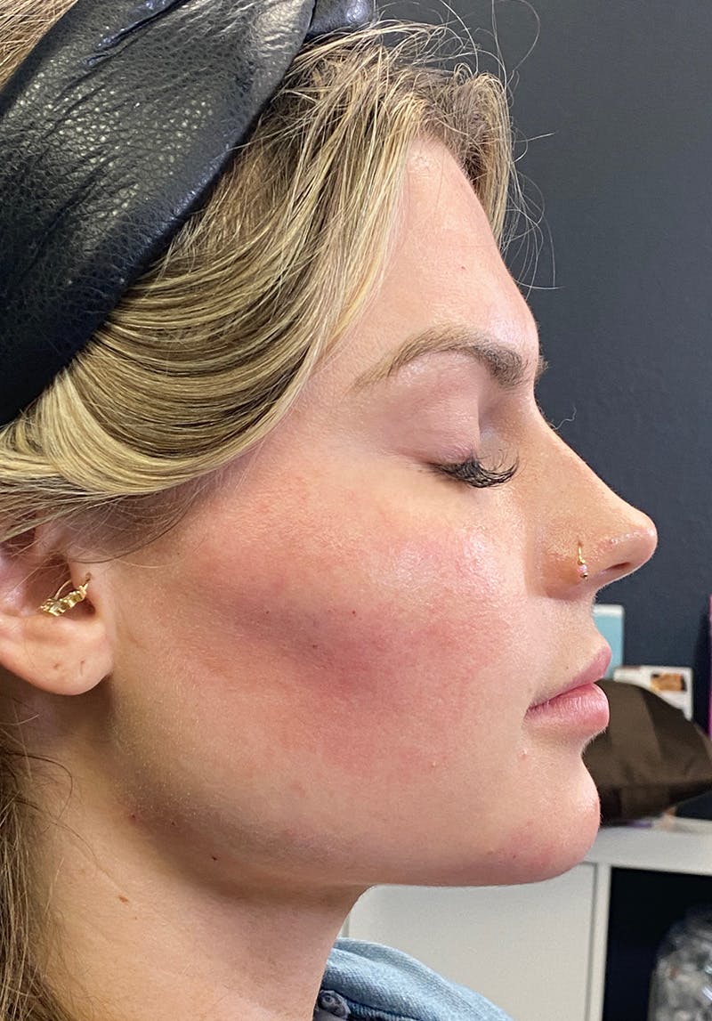 Dermal Fillers Before & After Gallery - Patient 142927795 - Image 6