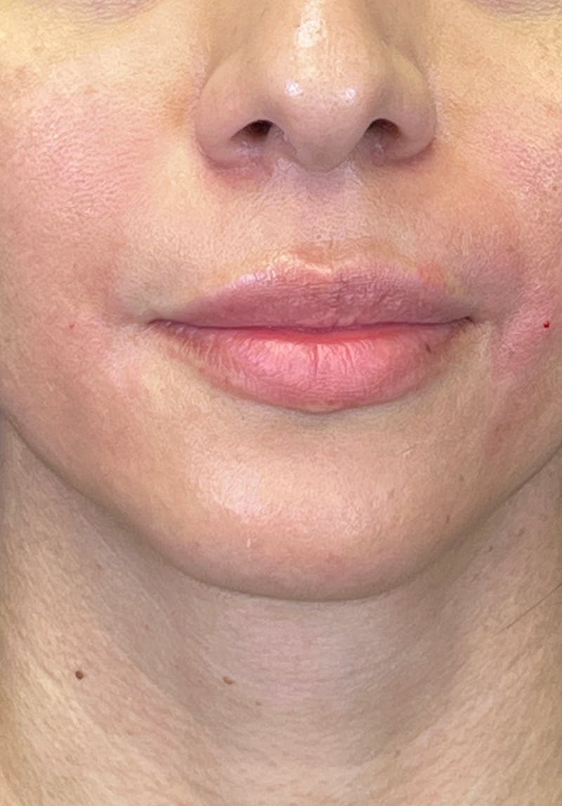 Dermal Fillers Before & After Gallery - Patient 142927792 - Image 2