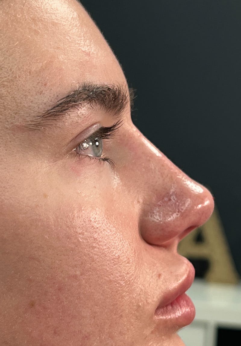 Dermal Fillers Before & After Gallery - Patient 142927793 - Image 4