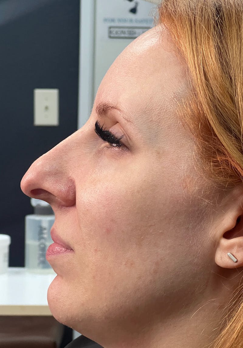 Dermal Fillers Before & After Gallery - Patient 142927791 - Image 1