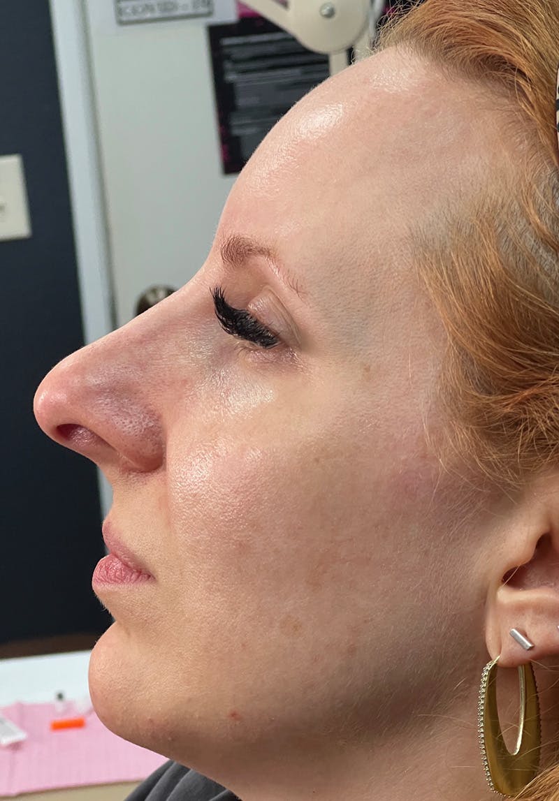 Dermal Fillers Before & After Gallery - Patient 142927791 - Image 2