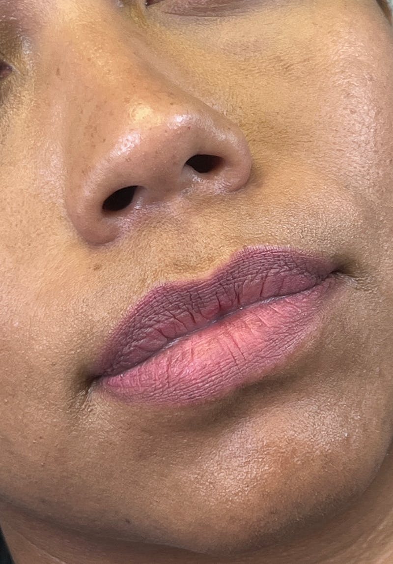 Dermal Fillers Before & After Gallery - Patient 142927790 - Image 1