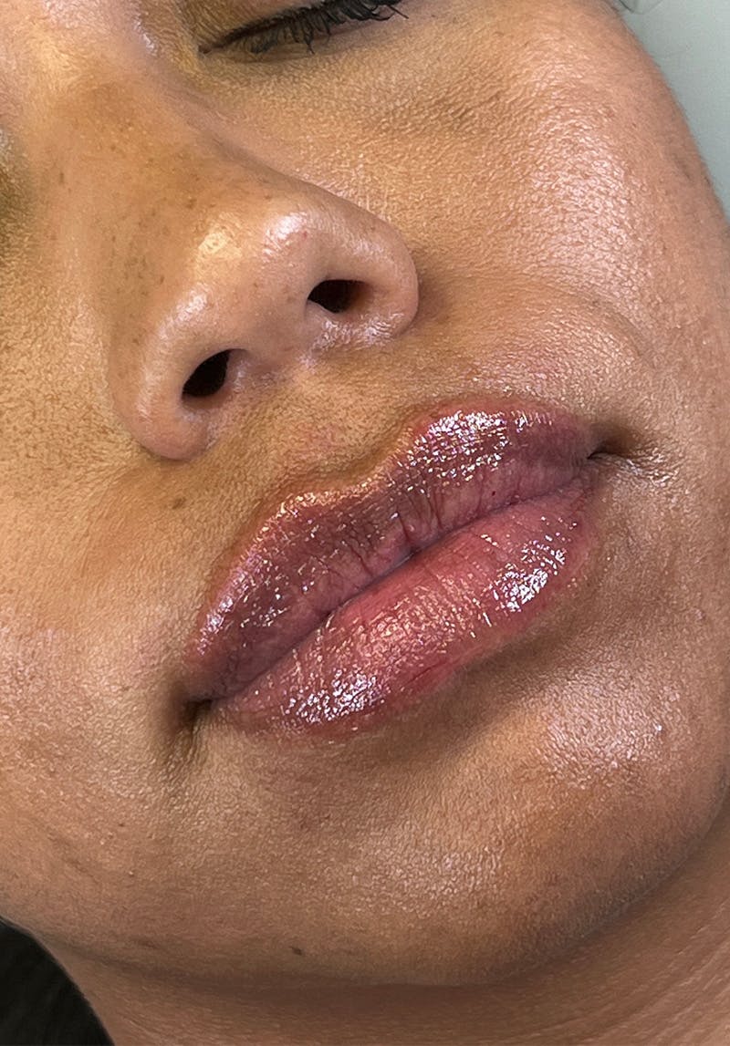 Dermal Fillers Before & After Gallery - Patient 142927790 - Image 2
