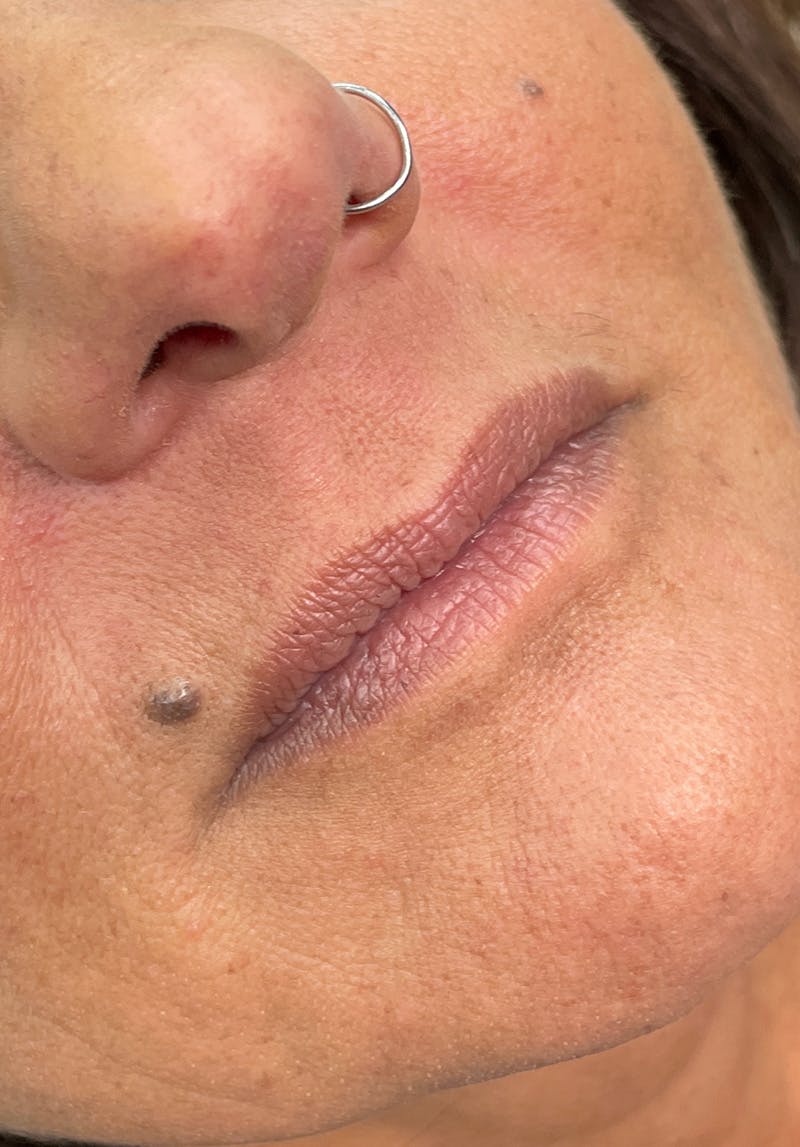 Dermal Fillers Before & After Gallery - Patient 142927789 - Image 1