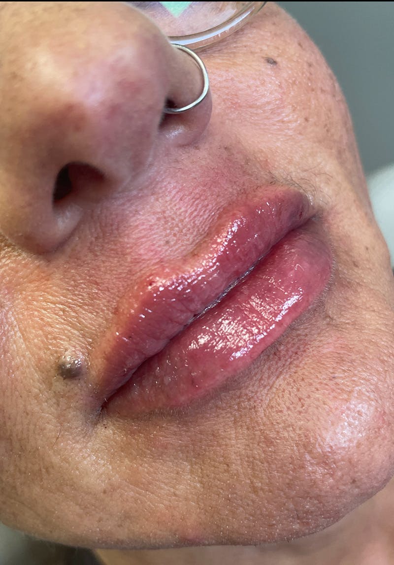 Dermal Fillers Before & After Gallery - Patient 142927789 - Image 2