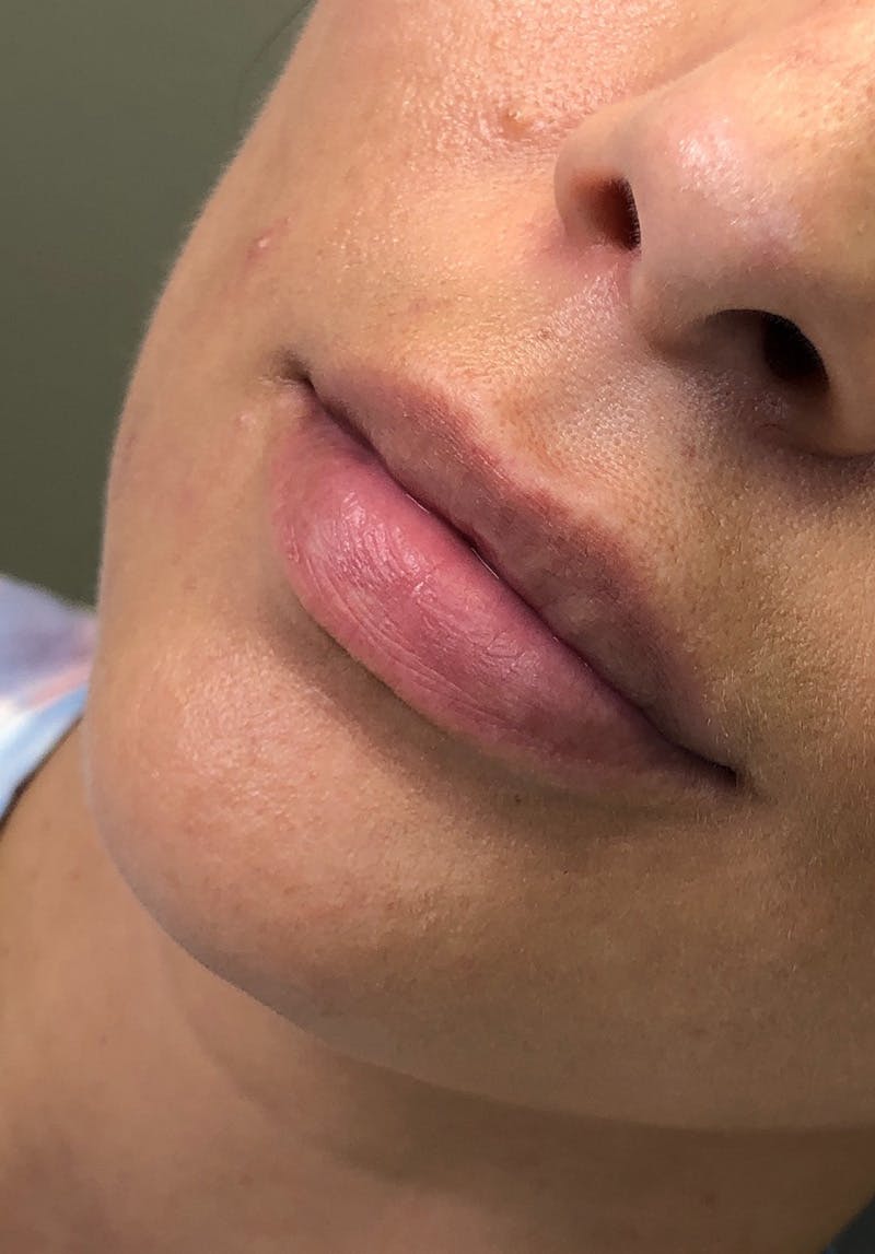 Dermal Fillers Before & After Gallery - Patient 142927787 - Image 1