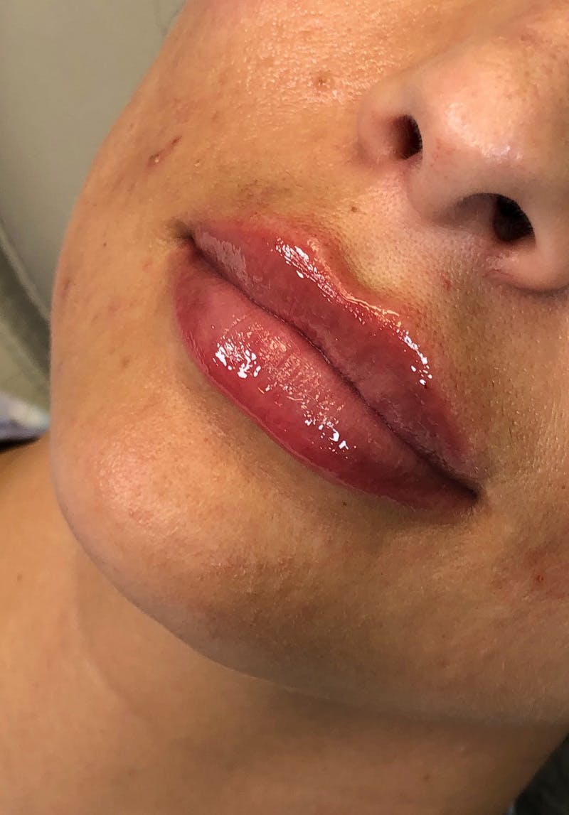 Dermal Fillers Before & After Gallery - Patient 142927787 - Image 2