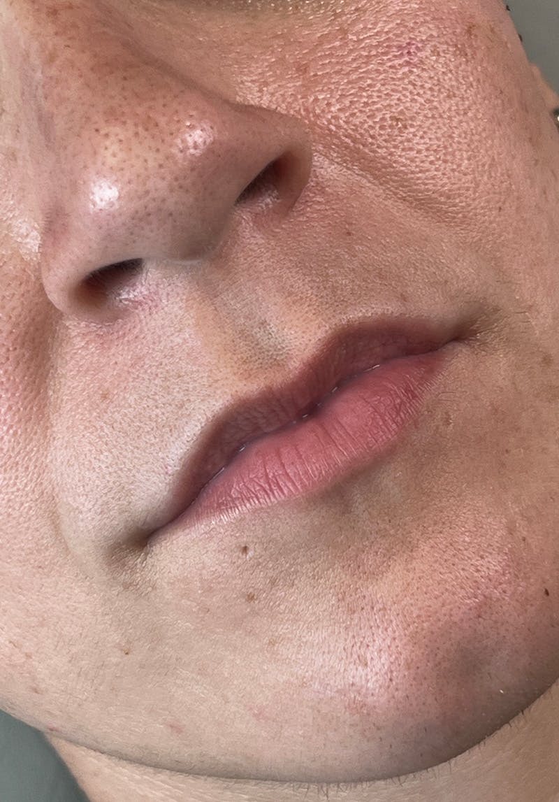 Dermal Fillers Before & After Gallery - Patient 142927786 - Image 1