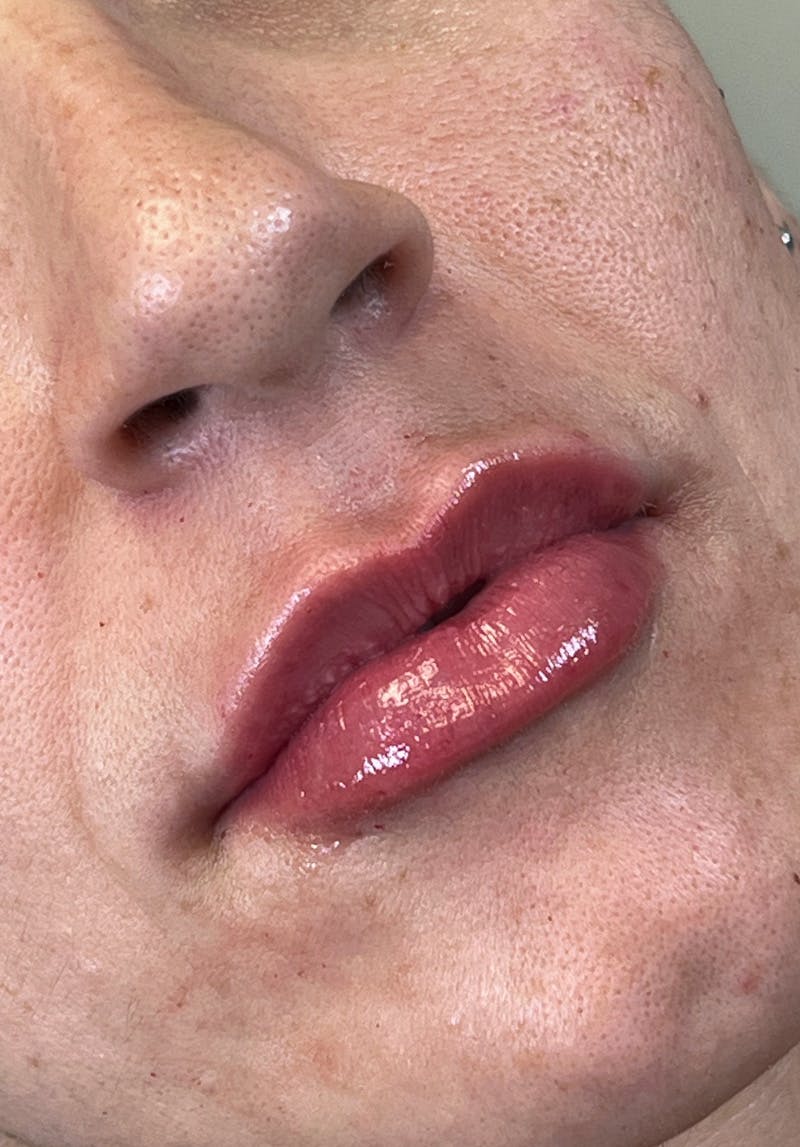 Dermal Fillers Before & After Gallery - Patient 142927786 - Image 2