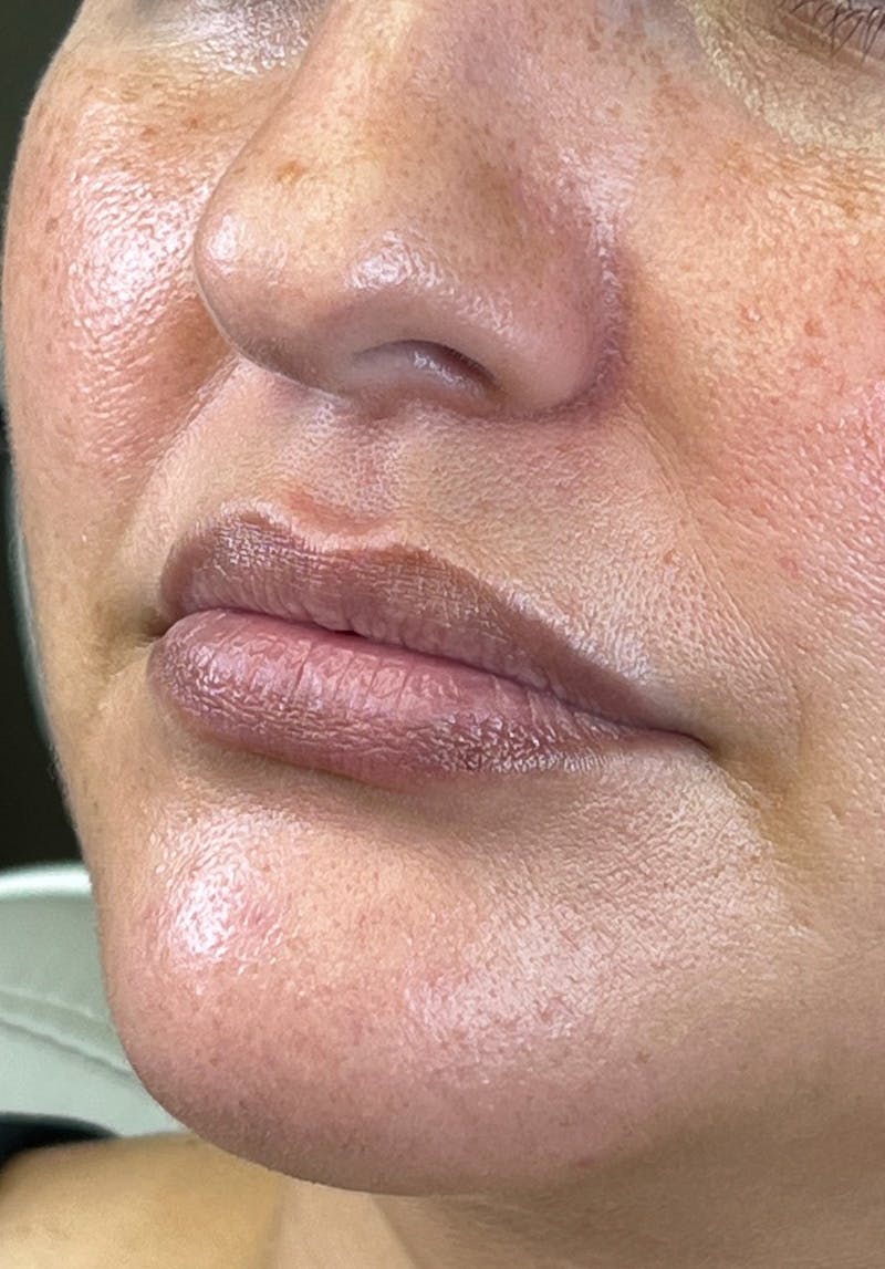 Dermal Fillers Before & After Gallery - Patient 142927785 - Image 1