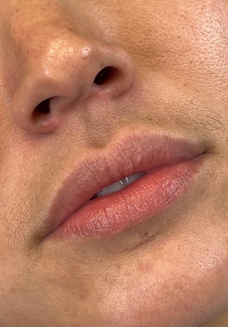 Dermal Fillers Before & After Gallery - Patient 142927788 - Image 1