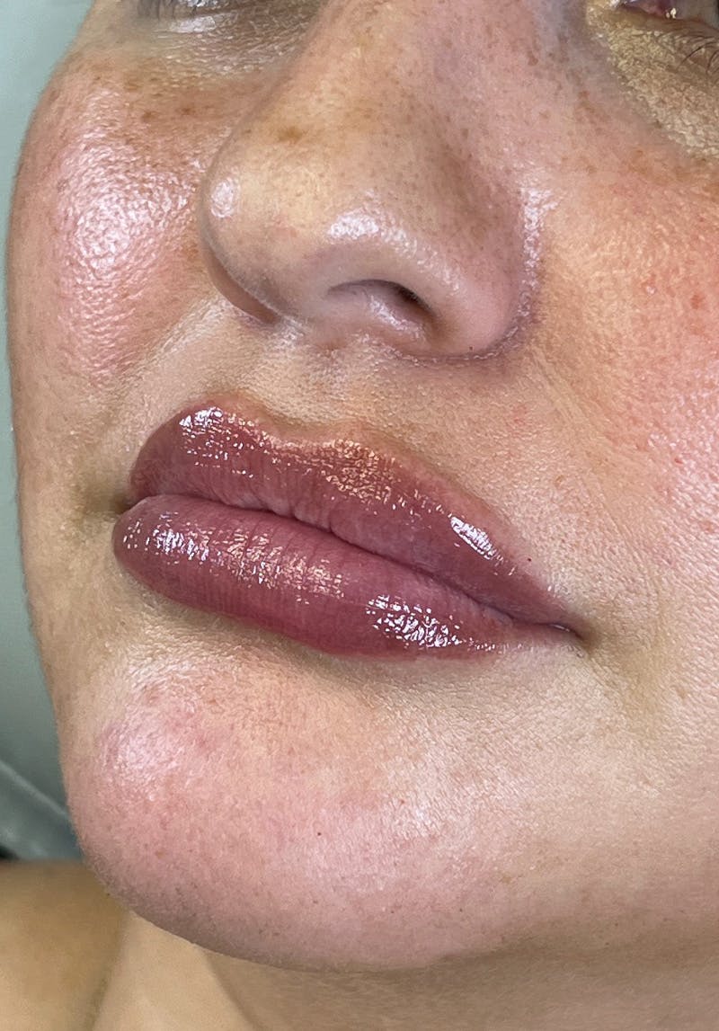 Dermal Fillers Before & After Gallery - Patient 142927785 - Image 2