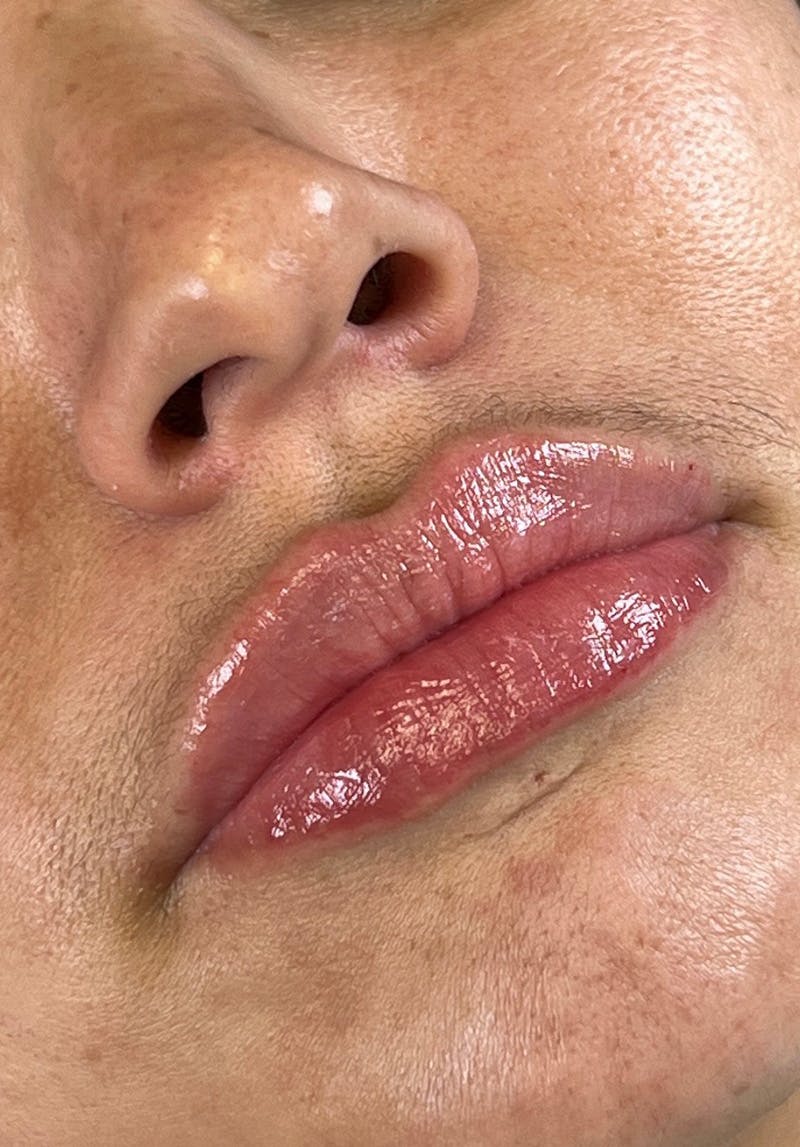 Dermal Fillers Before & After Gallery - Patient 142927788 - Image 2