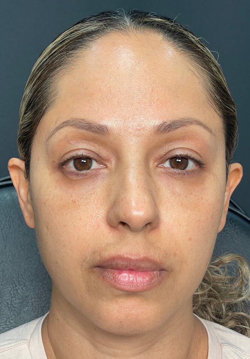 Dermal Fillers Before & After Gallery - Patient 142927784 - Image 1
