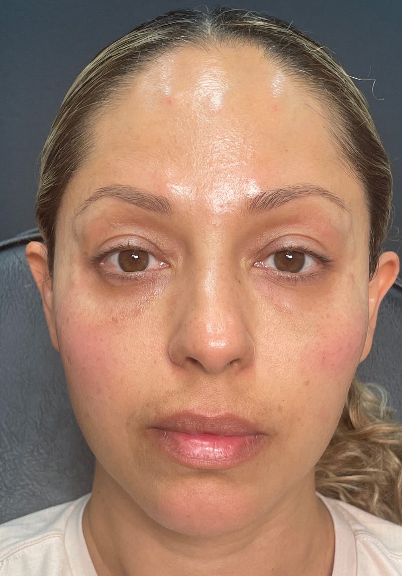 Dermal Fillers Before & After Gallery - Patient 142927784 - Image 2